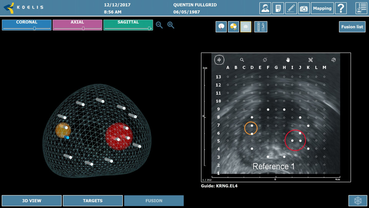 Trinity® Mri Us Obt Fusion® Prostate Biopsy System Urology Kebomed